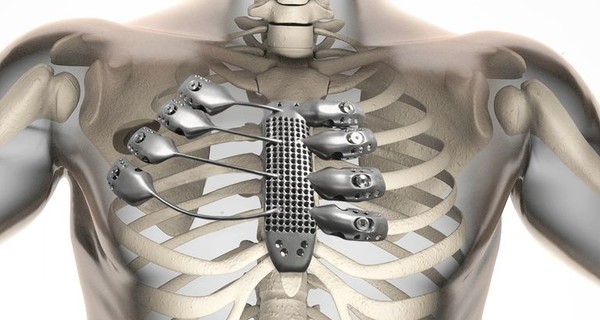 Испанцу пересадили ребра, напечатанные на 3D-принтере